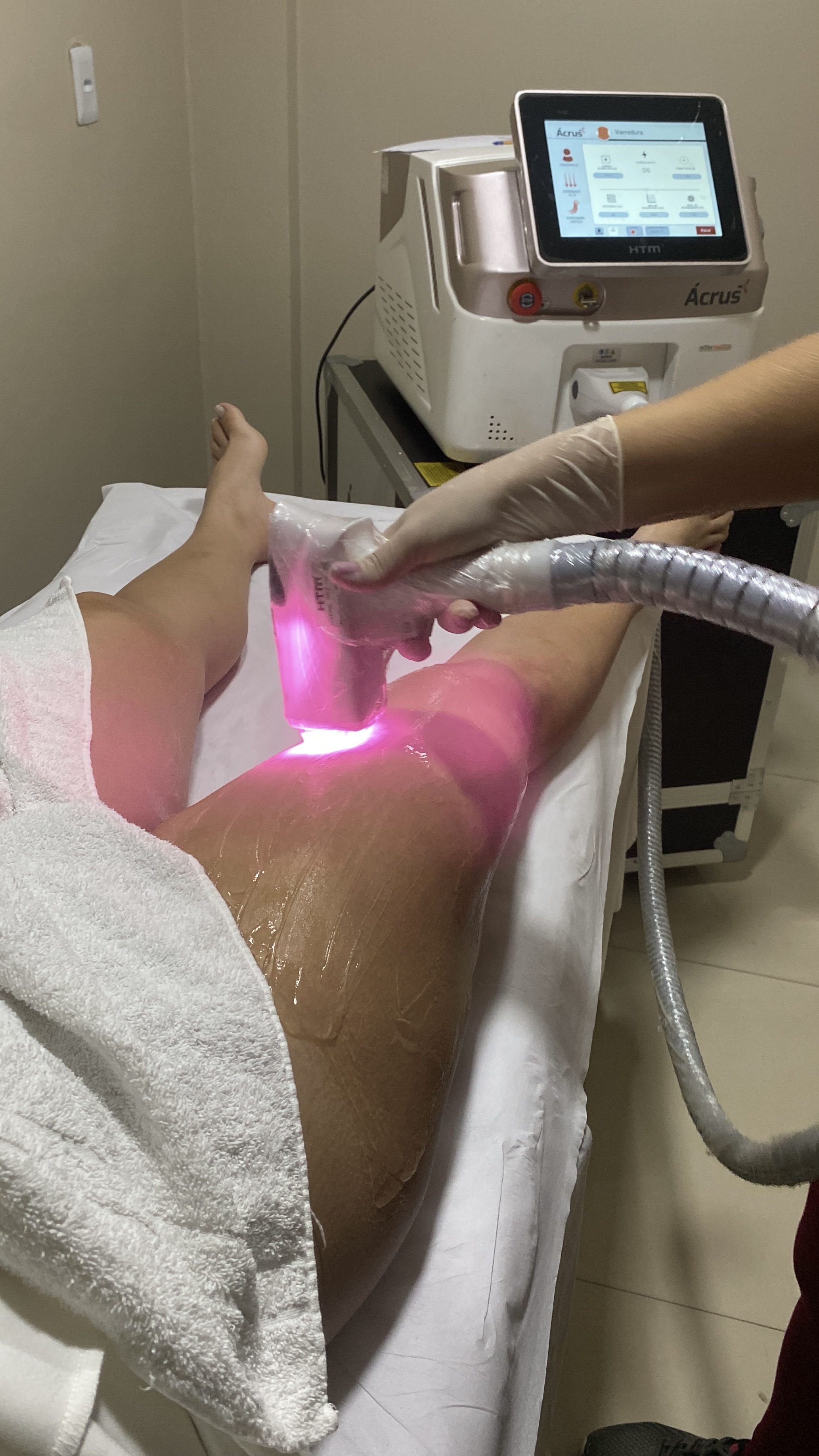 Depilação a Laser - Tecnologia Profissional